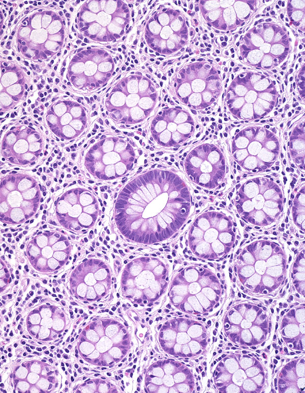 Crypt-adenoma600.jpg