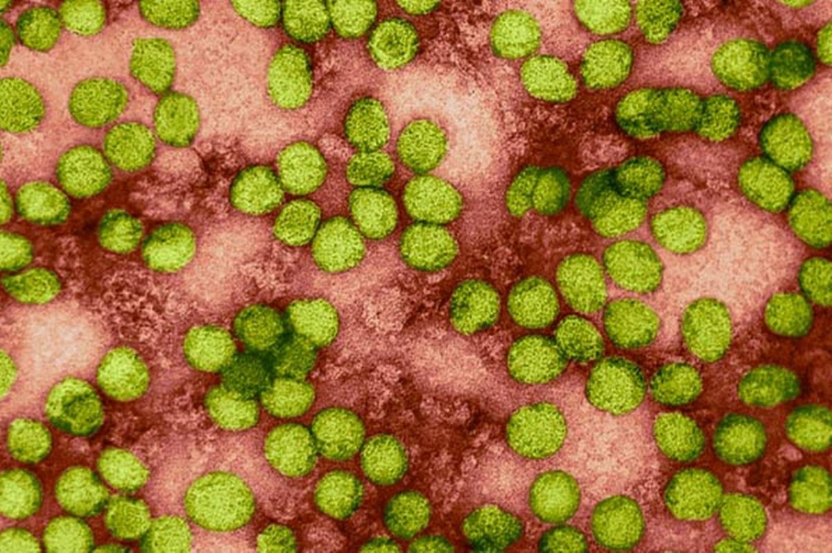 Hepatitis C.jpg