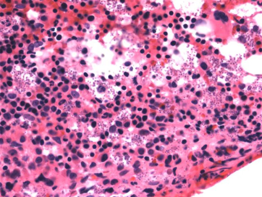 Visceral-leishmaniasis.jpg