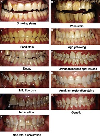 326px-Examples_of_tooth_staining.jpg