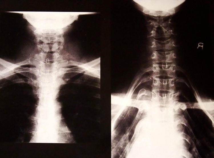 x-ray-kayan-extreme-female-body-modification.jpg